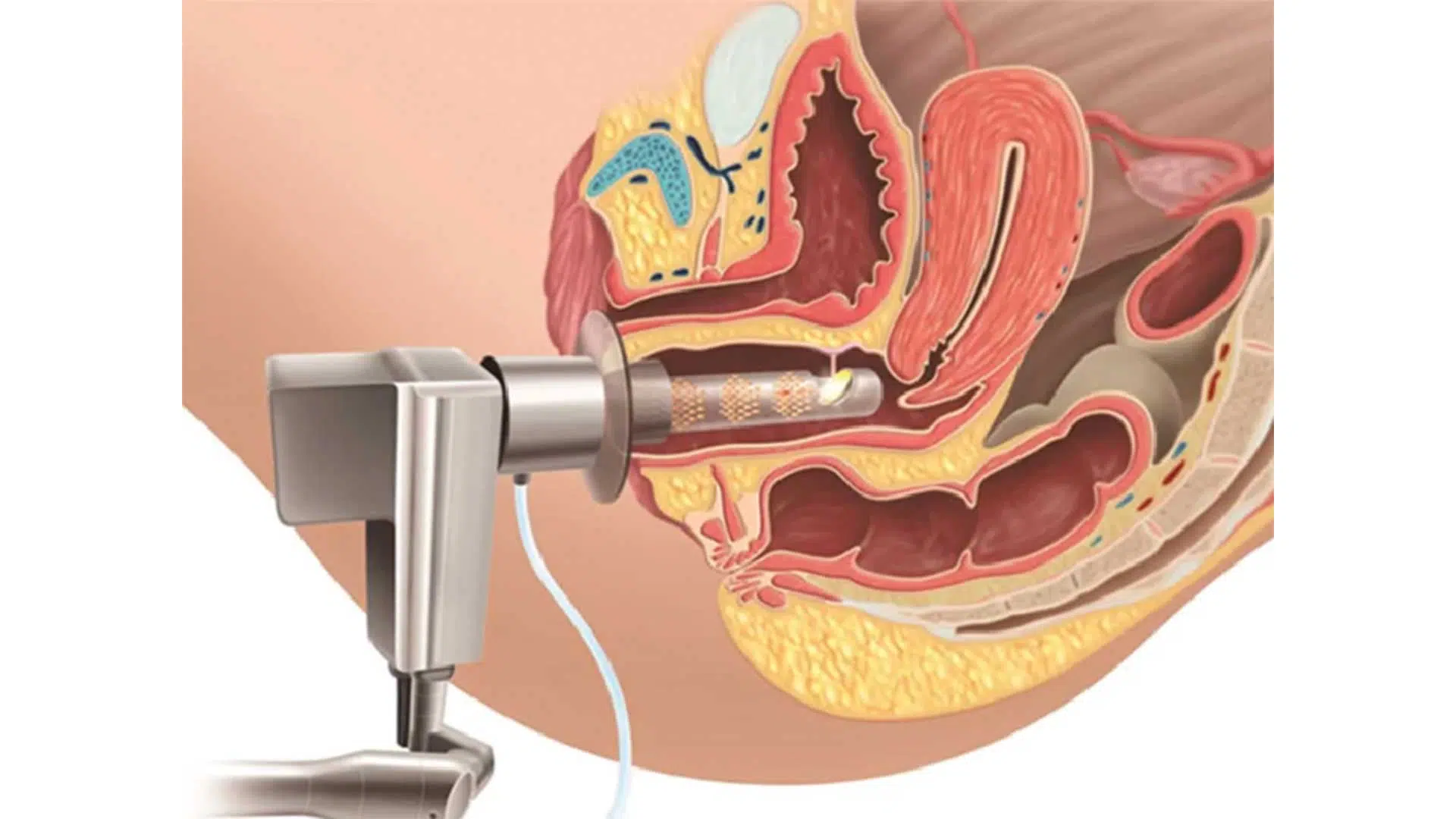 واژینوپلاستی